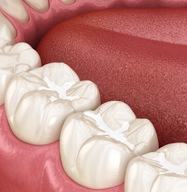 illustration of a dental filling