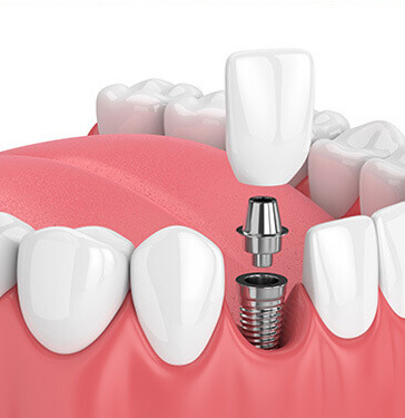 illustration of a dental implant