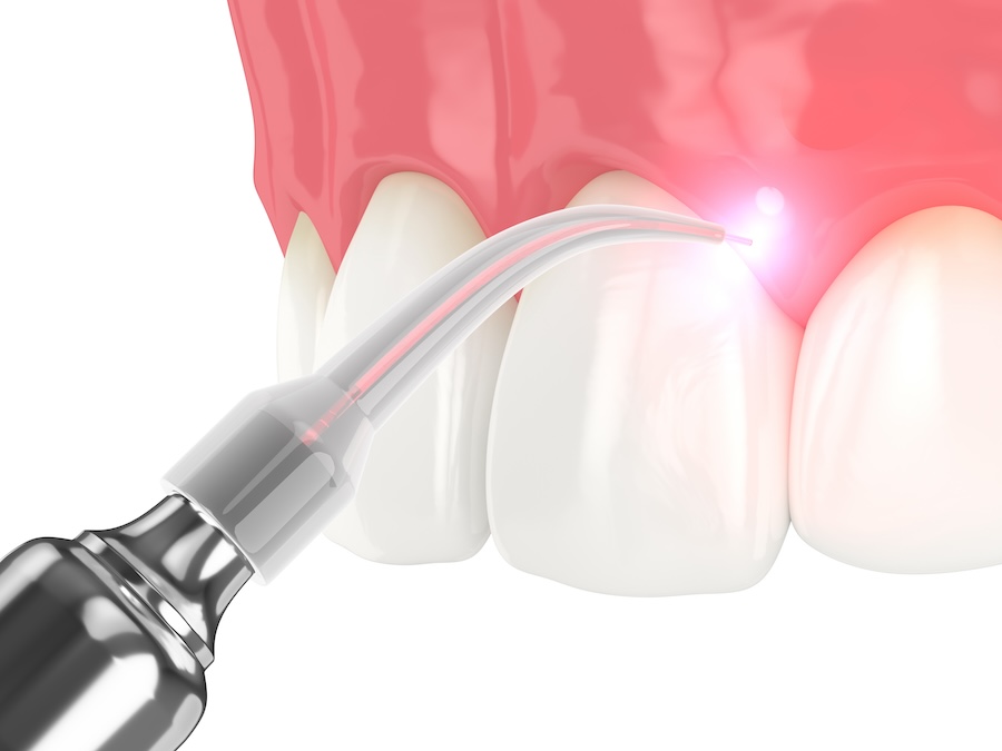 dental lasers, laser gum therapy, gum disease treatment, Colony Dental Care, Dr. James Oei, San Antonio TX dentist