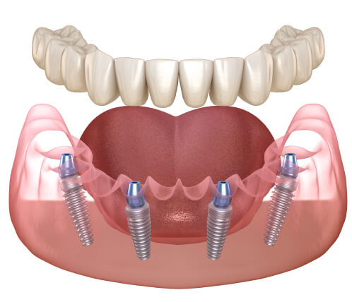 implant illustration